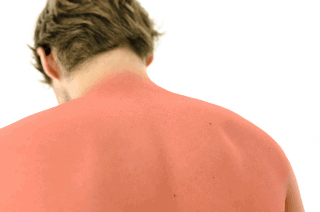 Ein Mann hat einen schweren Sonnenbrand auf dem Rücken